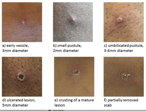 Explainer: What to Know About Monkeypox - Visual Capitalist